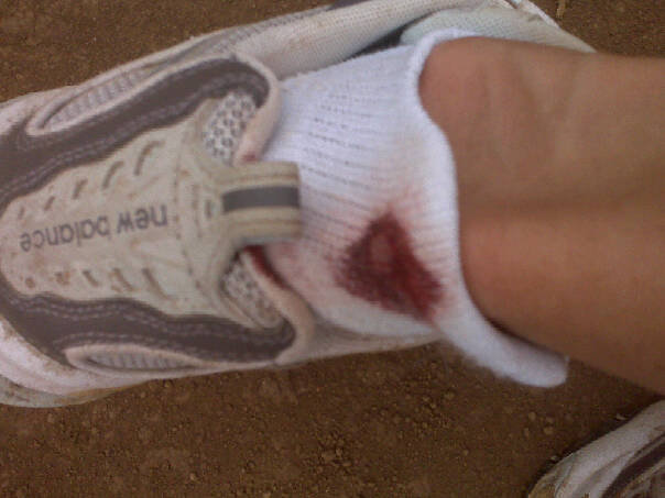 Cankle blood, aka her “Achillies foot.”
